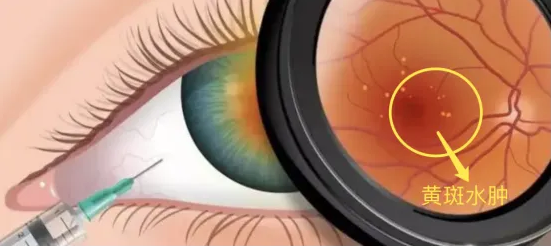 “瞎”了半年，一针重见光明